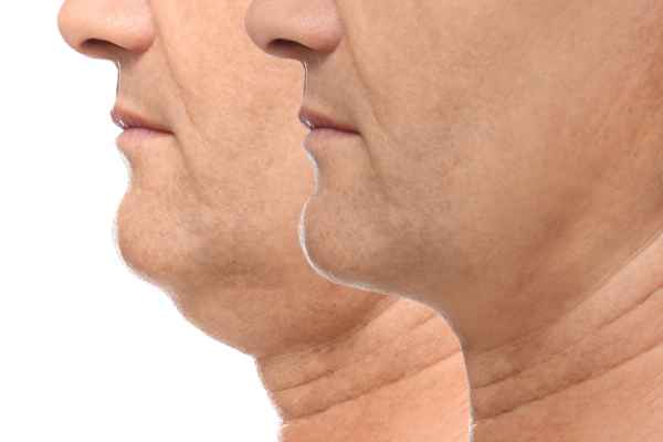 HIFU - Breakthrough in Anti - ageing 2 hifu results Northwich