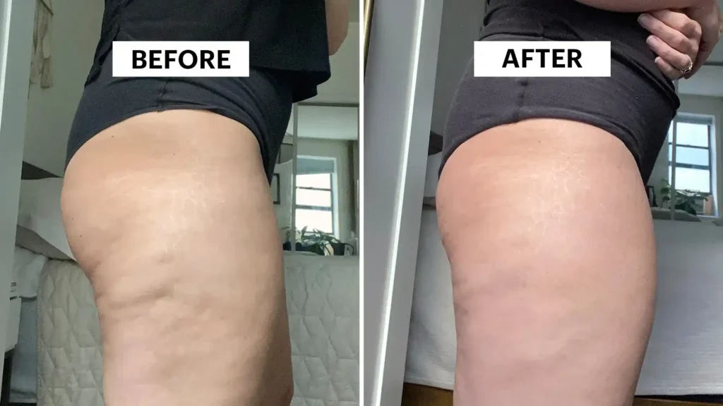 Sculpting Your Bum: Can Toning Exercises Really Reduce Cellulite? 1 Do Toning Exercise Northwich Really Tackle Cellulite?