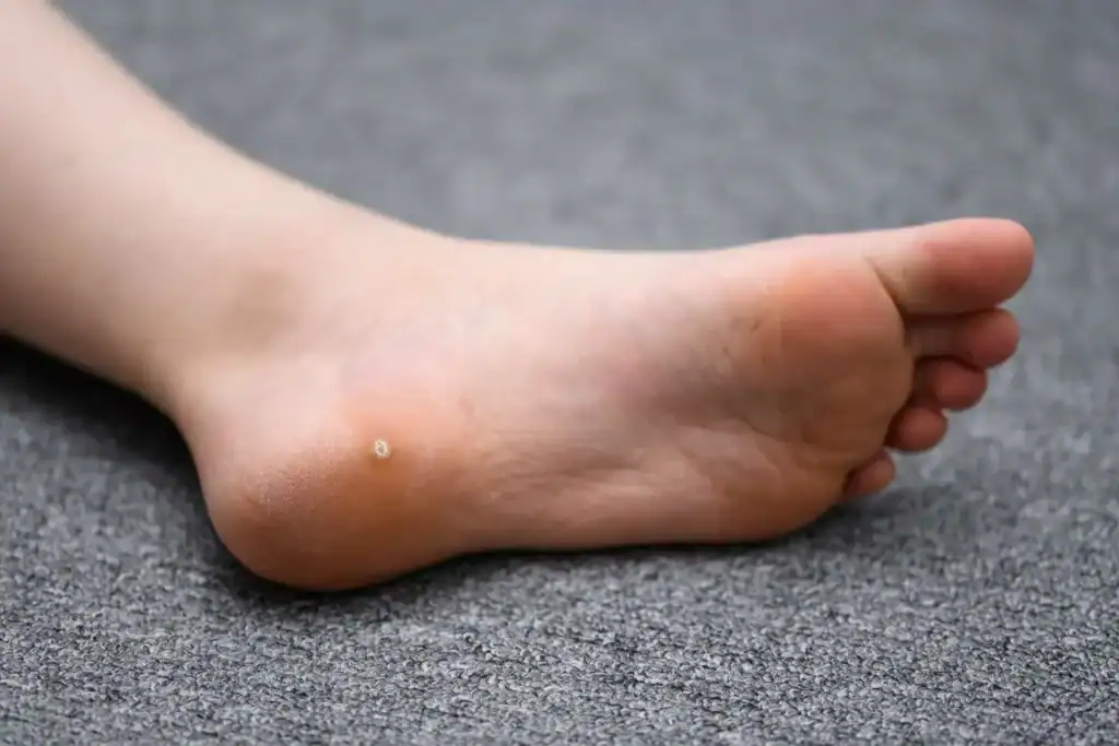 Cryotherapy For Warts And Also Verrucas 2 Image of verruca on the bottom of the foot that able to be treated with Cryotherapy Northwich