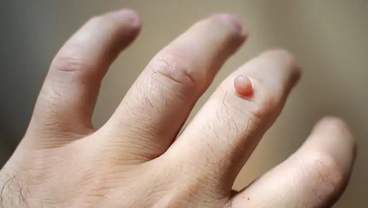 Cryotherapy For Warts And Also Verrucas 1 Image of blemish that Cryotherapy Northwich can remove with Lipo 360.