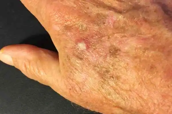 Image of Actinic keratoses Northwich on a person hand