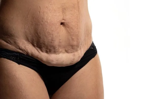 The Science of Skin Tightening 1 The science behind skin tightening Northwich picture of a woman's sagging skin on the stomach